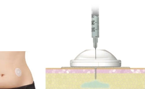 i-port injections