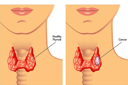 diabetes, thyroid and endocrinology treatment in Kochi