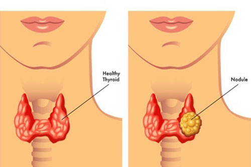 diabetes, thyroid and endocrinology treatment in Kochi